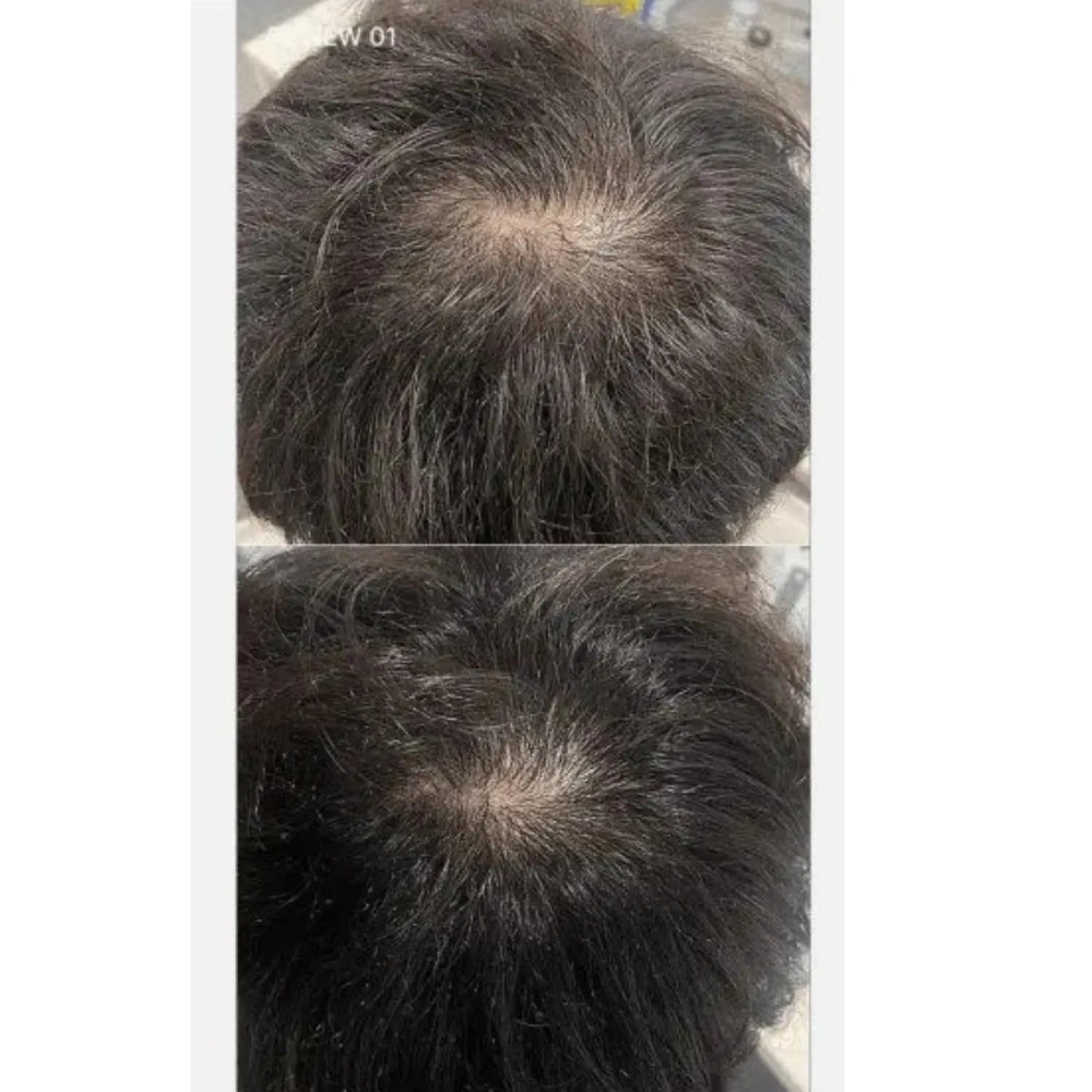 Medicube SOYXIDIL Shampoo - Σαμπουάν κατά της τριχόπτωσης