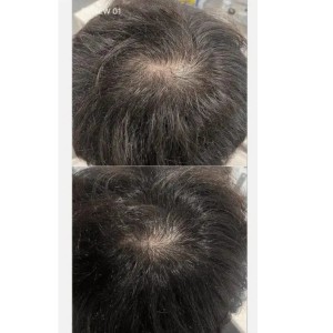 Medicube SOYXIDIL Shampoo - Σαμπουάν κατά της τριχόπτωσης